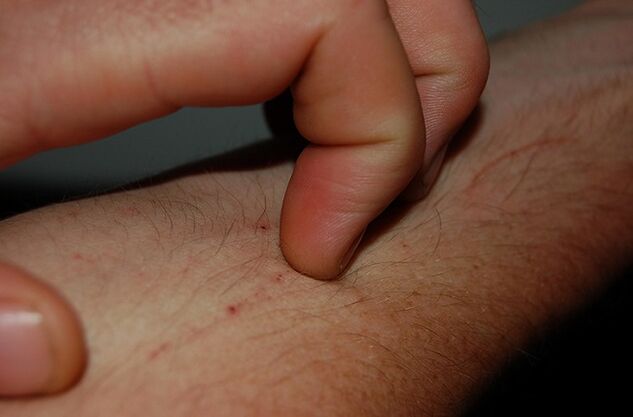 Itchy skin as a symptom of the presence of parasites