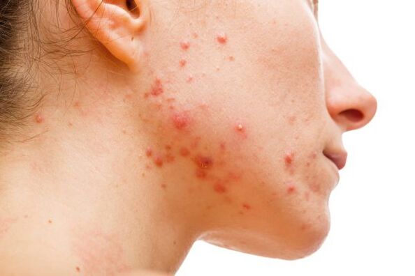 Acne caused by subcutaneous parasites