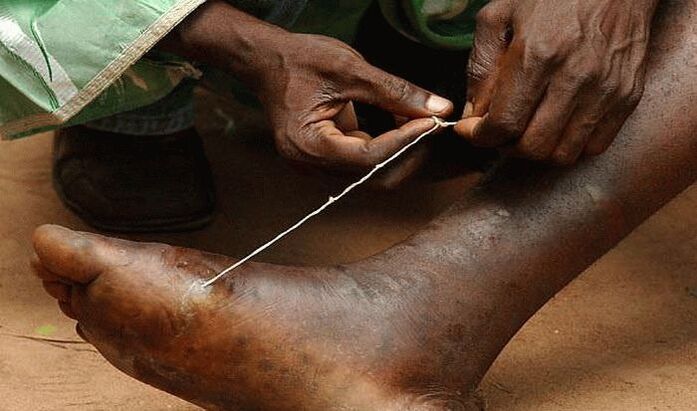 extraction of subcutaneous parasites from the legs