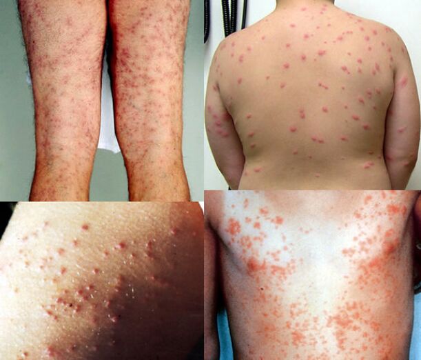 rash all over the body due to parasites