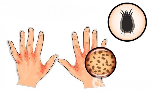 scabies in humans due to parasites