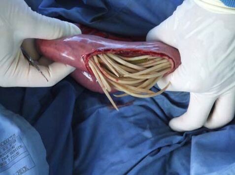 intestinal parasites