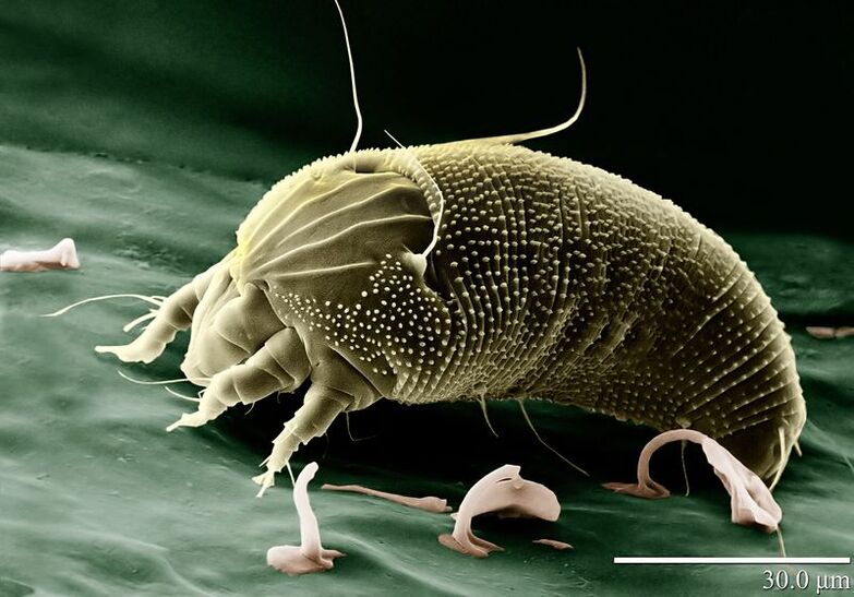 mite scabies